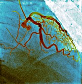 Normal blood vessels,X-ray