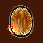 Brain cancer after surgery,MRI scan