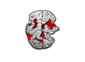 Damaged human brain