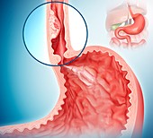 Oesophageal cancer,illustration