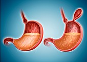 Stomach with and without hernia