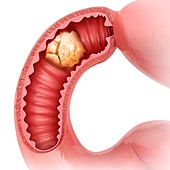 Small intestine with tumor,illustration