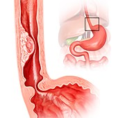 Oesophageal cancer,illustration