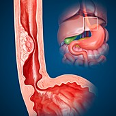 Oesophageal cancer,illustration