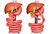 Gastric bypass,illustration