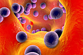 Staphylococcus infection,illustration