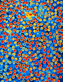 Coloured TEM of polio virus virions