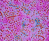 False-colour TEM of hepatitis B viruses