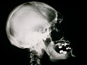 X-ray of human skull showing acromegaly