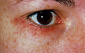 Acne agminata; rash around woman's eye