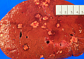 Specimen of human liver with aspergillosis