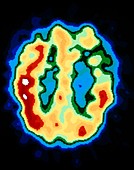 PET brain scan: Alzheimer's disease