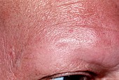 Alopecia areata (hair loss) of eyebrow in man