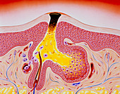 Artwork of acne,showing blackhead development