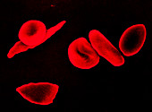 SEM of red blood in sickle cell anaemia