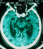 CT scan of brain with Alzheimer's disease,aged 66