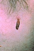 Close-up of a skin tag