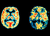 Normal and Alzheimer's disease brains