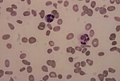 LM of a blood smear in pernicious anaemia