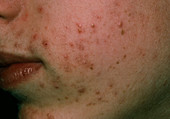 Acne vulgaris on cheek of a teenager