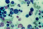 LM of bone marrow in megaloblastic anaemia