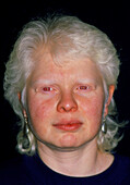 Face of a 37-year-old woman with albinism