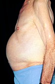 Ascites: side view of a man's distended abdomen