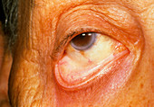 Pale eyelid due to myelodysplastic anemia