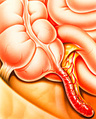 Artwork of an appendix with appendicitis