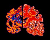Artwork of Alzheimer's diseased brain vs normal