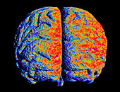 Artwork of brain with Alzheimer's disease