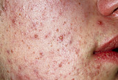 Acne vulgaris on the face of a young man