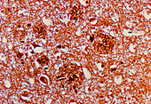 LM of brain tissue affected by Alzheimer's disease