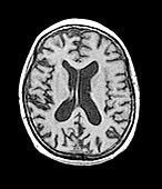 Alzheimer's disease MRI