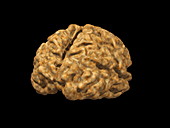Alzheimer's disease brain,3-D MRI
