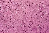 Alzheimer's disease brain tissue