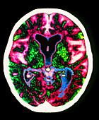 Alzheimer's disease brain,CT scan