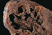 Lung abscess