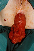 Rectal adenoma protruding through anus
