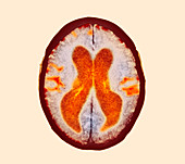Alzheimer's disease brain,coloured CT scan