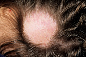 Alopecia