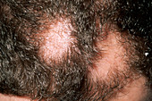 Alopecia areata