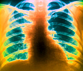 Glandular disease,X-ray