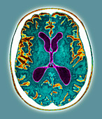 Alzheimer's disease,MRI scan