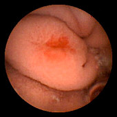 Angiodysplasia of the duodenum