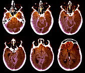 Brain with Alzheimer's disease,CT scan