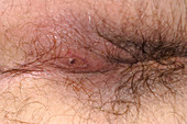 Perianal abscess