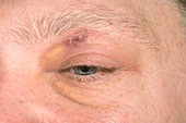 Healing eyelid abscess