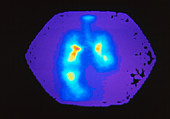 Coloured Gamma scan of the lungs of an asthmatic