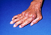 Deformation of hand due to rheumatoid arthritis